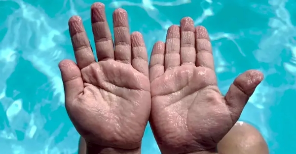 Ζαρώνουν τα δάχτυλά σου στο νερό; Μπορεί να σημαίνει περισσότερα απ’ όσα νομίζεις...