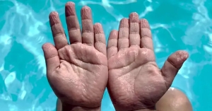 Ζαρώνουν τα δάχτυλά σου στο νερό; Μπορεί να σημαίνει περισσότερα απ’ όσα νομίζεις...